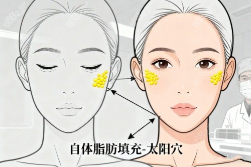 脂肪填充太陽穴卡通圖