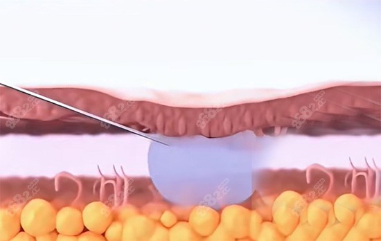 緊縮針填充私密位置照片