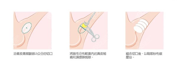 顧建成微波腋臭治療費(fèi)用3萬左右