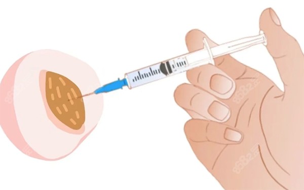 緊縮針一支多少錢？ 2026緊縮針品牌選擇、維持時間及私密緊致價格
