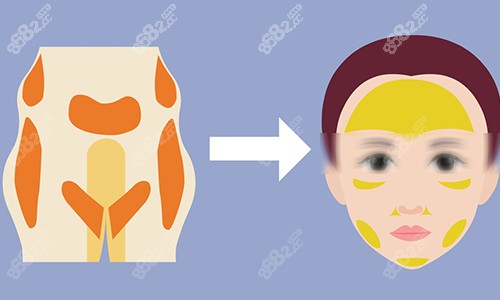 脂肪填充動畫圖