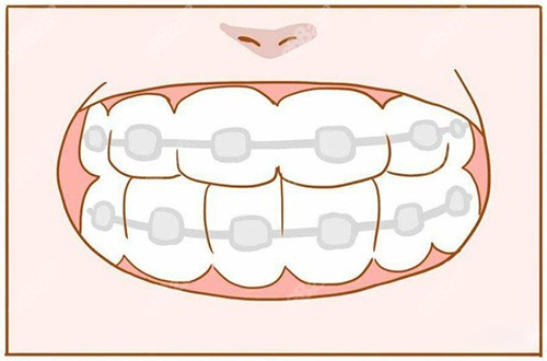 牙齒矯正漫畫展示圖