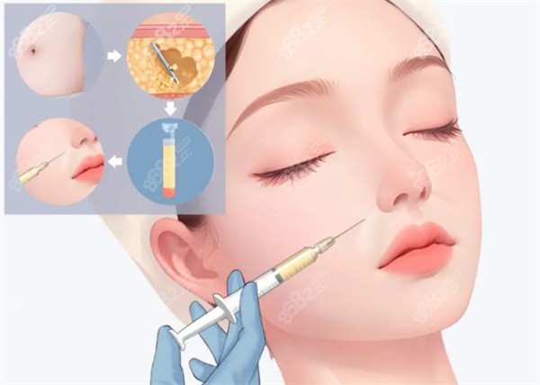 自體脂肪填充整形手術圖片