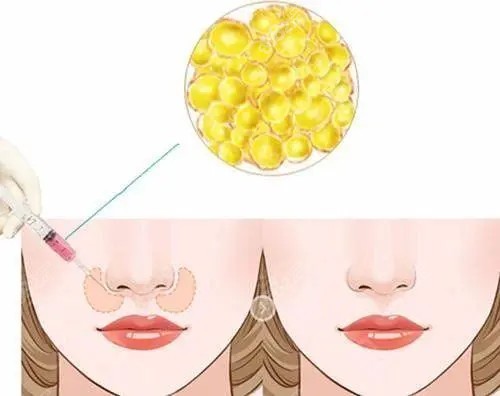 脂肪填充鼻基底位置示意圖