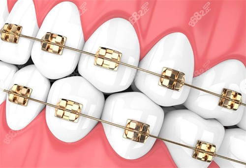 金屬牙齒矯正