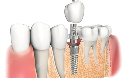 種植牙材料展示
