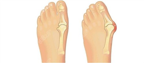 大腳骨手術(shù)前后對比
