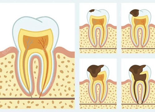 牙齒齲壞不同程度圖片