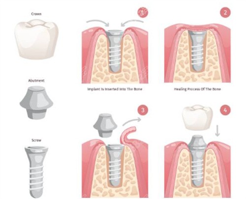 武漢2026種植牙價格是多少？ 匯總武漢正規(guī)口腔集采后韓系/德系種植費