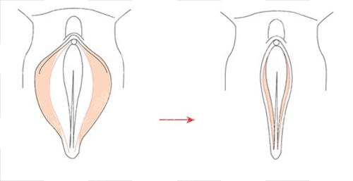 女性私密手術(shù)外陰動(dòng)畫展示