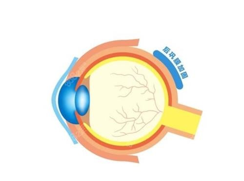 段安麗和薛安全哪個做后鞏膜加固好？醫(yī)生手術(shù)風(fēng)格、預(yù)約難度及術(shù)后控制