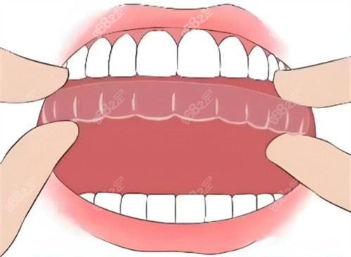 隱形矯正圖片展示