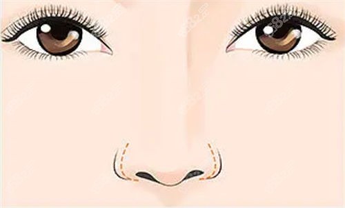 李長富醫(yī)生做鼻子技術(shù)好不好？ 2026李長富肋骨鼻/鼻修復(fù)風(fēng)格及真實術(shù)例