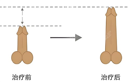 男生增大增粗示意圖 男生增大增粗示意圖