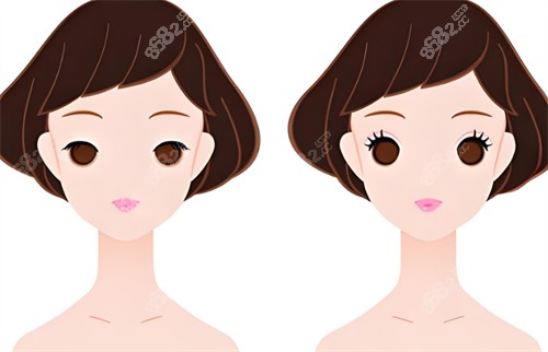 雙眼皮前后對(duì)比圖 雙眼皮前后對(duì)比圖