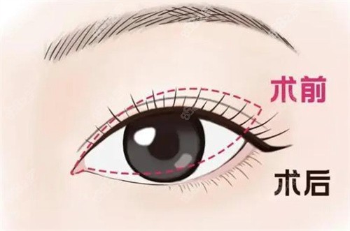 雙眼皮修復手術(shù)對比