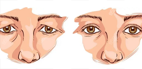 雙眼皮修復(fù)前后 雙眼皮修復(fù)前后