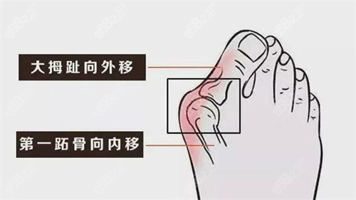 大腳骨的癥狀