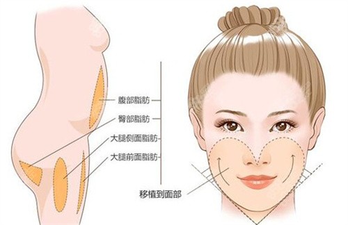 北京王明利自體脂肪填充價(jià)格貴嗎？技術(shù)好存活率高，價(jià)格透明值得看！