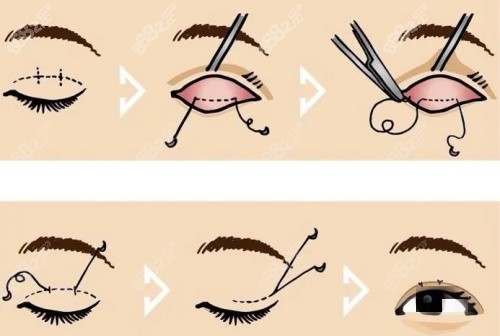 雙眼皮操作示意圖