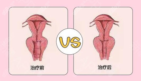陰道緊縮針前后對比
