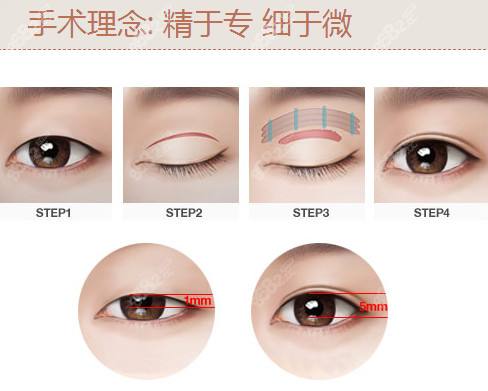 黃海俠醫(yī)生雙眼皮抽脂深圳藝星醫(yī)院可預(yù)約掛號