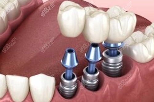 種植牙卡通圖展示