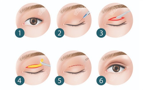 雙眼皮全切手術(shù)過程 雙眼皮全切手術(shù)過程