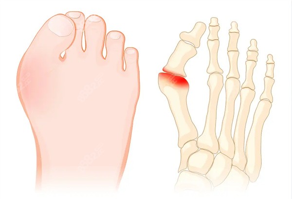 大腳骨矯正術(shù)