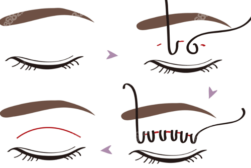 埋線雙眼皮手術(shù)步驟圖