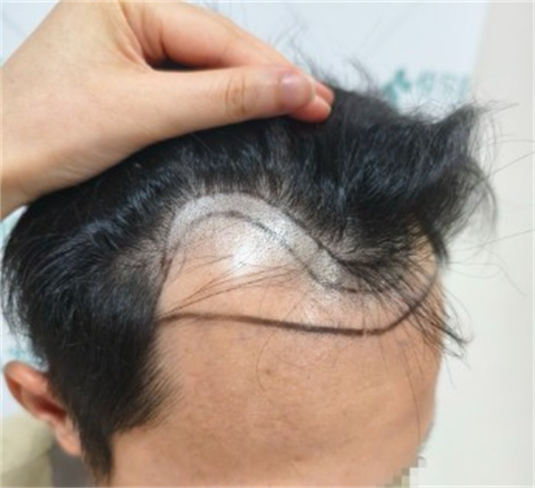 成都碧蓮盛植發(fā)醫(yī)院24小時人工客服電話公布！超100位醫(yī)生+先進技術(shù)，看成功案例見證逆天植發(fā)效果！ 