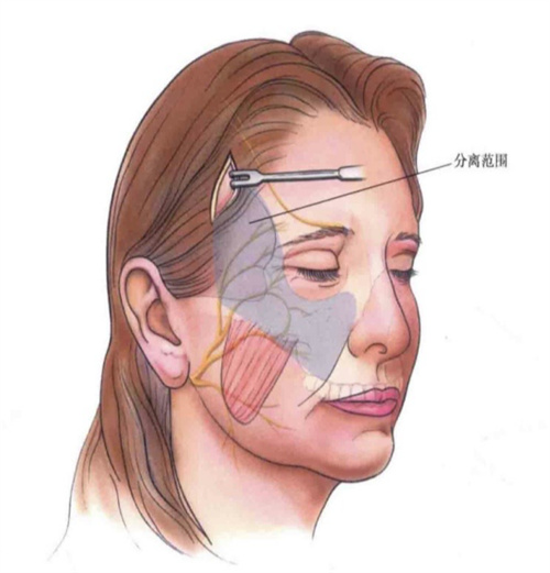 王乙立的無痕筋膜提升靠譜嗎？揭秘醫(yī)生資質(zhì)與真實(shí)案例，告別線雕焦慮，3.8萬提升效果勝過熱瑪吉