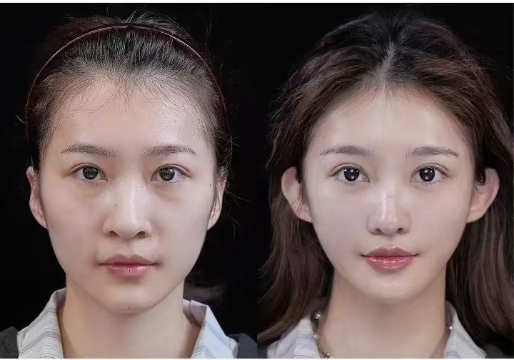 四、成都軍大蒲小兵醫(yī)生吸脂失敗修復(fù)