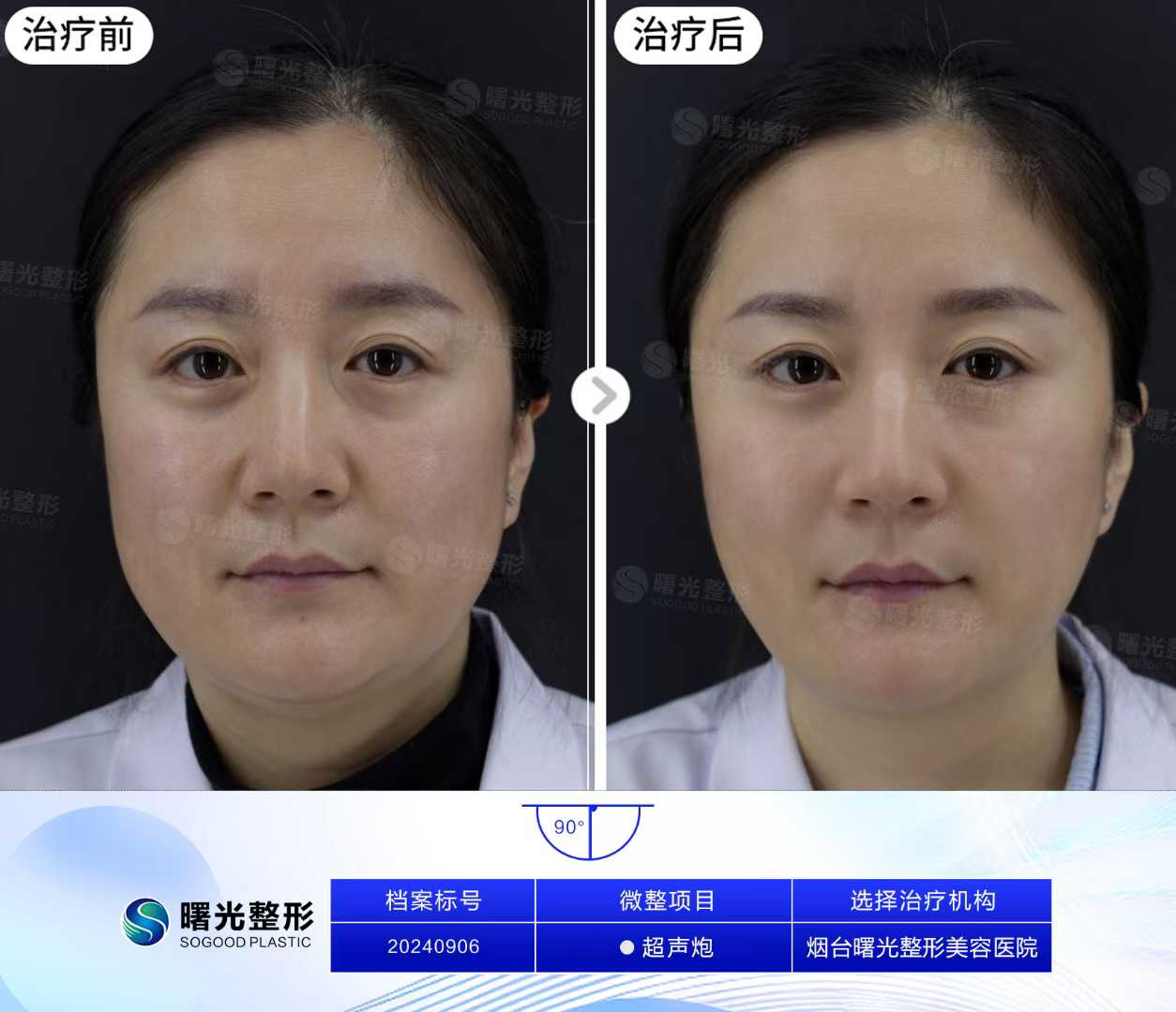 廣州華美醫(yī)療美容醫(yī)院：祛眼袋項(xiàng)目豐富