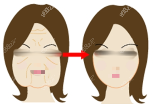 拉皮前后明顯對(duì)比圖