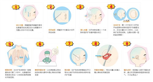 擴(kuò)張器法耳再造手術(shù)動(dòng)畫(huà)演示圖 擴(kuò)張器法耳再造手術(shù)動(dòng)畫(huà)演示圖