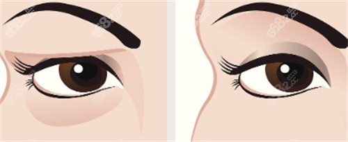 祛眼袋前后對(duì)比2 祛眼袋前后對(duì)比2