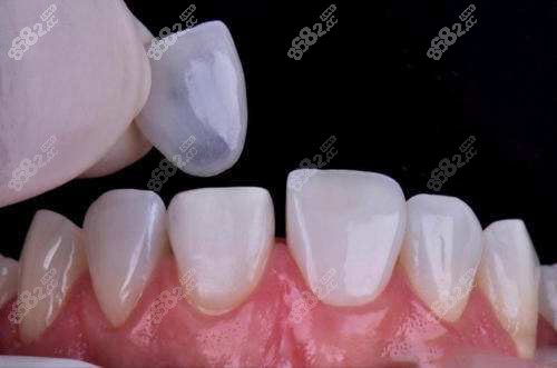 牙齒貼面過程