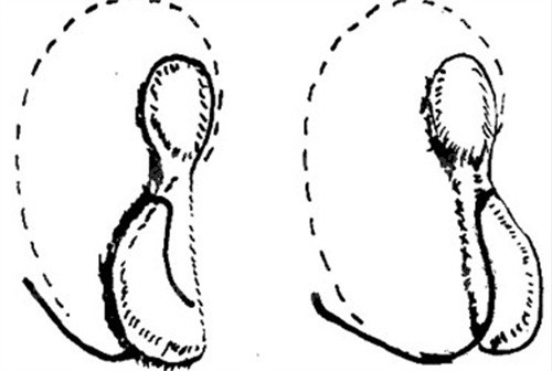 萬偉東耳再造多少錢？ 2026萬偉東院長肋軟骨/支架造耳面診指南