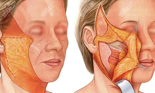 拉皮手術(shù)過(guò)程動(dòng)畫(huà)示意圖