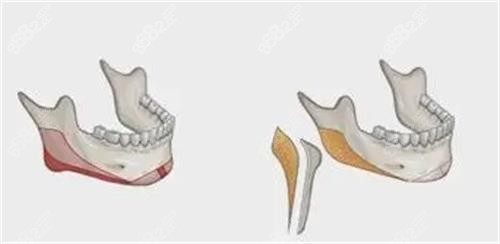 削骨磨骨示意圖 削骨磨骨示意圖