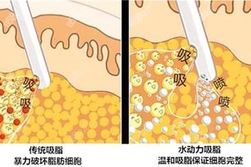 吸脂示意圖 吸脂示意圖