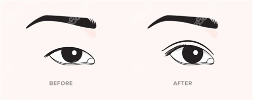 雙眼皮手術(shù)前后對比 雙眼皮手術(shù)前后對比