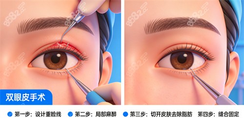 雙眼皮手術(shù)過程解析 雙眼皮手術(shù)過程解析