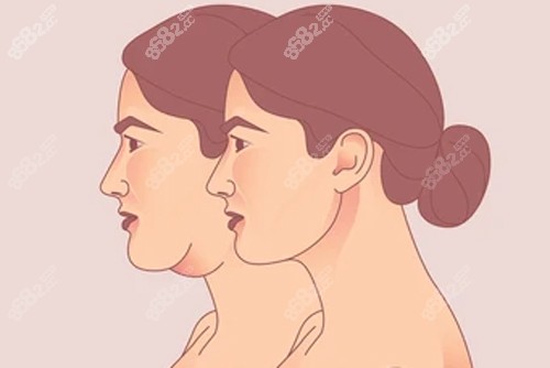 李建鋼筋膜提升做的怎么樣？從技術(shù)原理到術(shù)后結(jié)果，一文全解析！