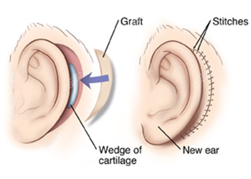 耳再造手術的切口 耳再造手術的切口