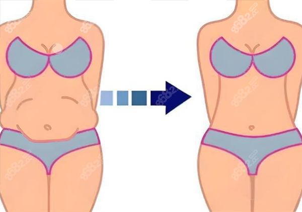 腹壁成形術(shù) 腹壁成形術(shù)