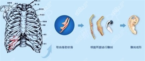耳再造手術肋軟骨雕刻 耳再造手術肋軟骨雕刻