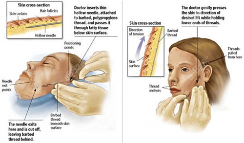 面部提升圖片對比