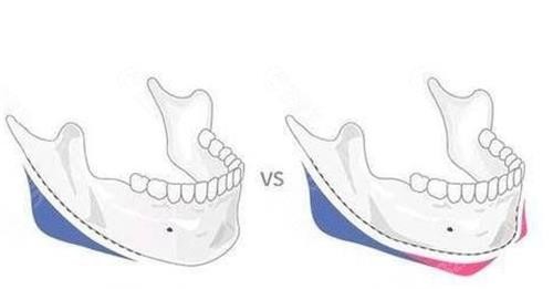 磨骨前后對比示意圖 磨骨前后對比示意圖